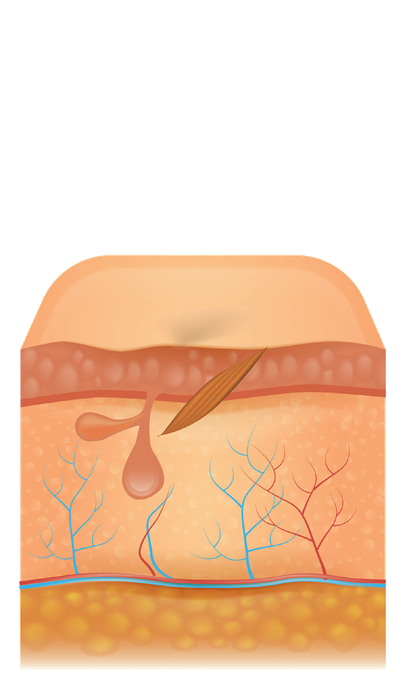 Illustrazione: il follicolo coagulato e la caduta del pelo